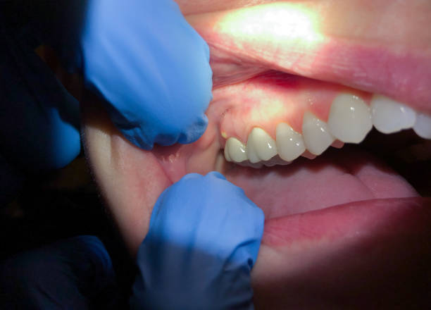 Best Emergency Wisdom Tooth Extraction in Canyon, TX